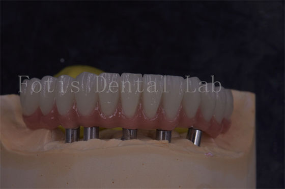 Des couronnes d'implants dentaires personnalisables pour une apparence naturelle et des restaurations confortables
