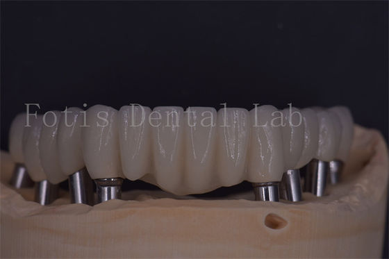 Des implants dentaires fiables pour le confort et la fonctionnalité