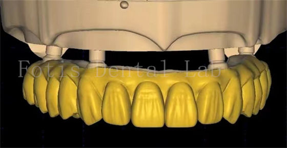 La conception d'une couronne dentaire OEM utilise des technologies avancées de numérisation et d'impression 3D