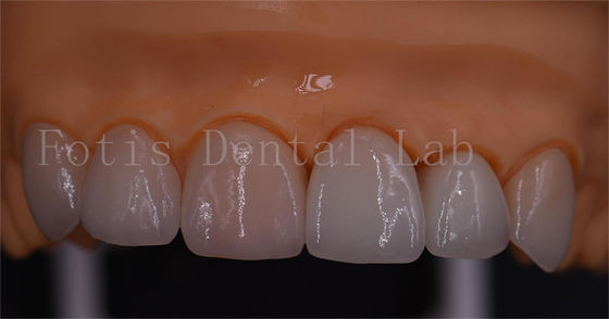 3 formes couronnes numériques bonne compatibilité design dentures 1 jour livraison