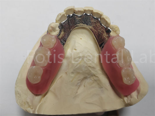 Denture partielle amovible flexible facile à nettoyer / entretenir