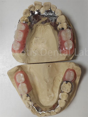 Prothèses temporaires partielles compatibles avec les dents naturelles