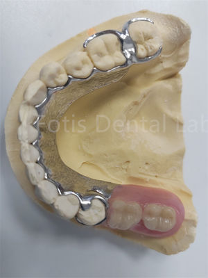 Remplacer les dents manquantes Prothèse partielle amovible Prothèse dentaire Conception flexible
