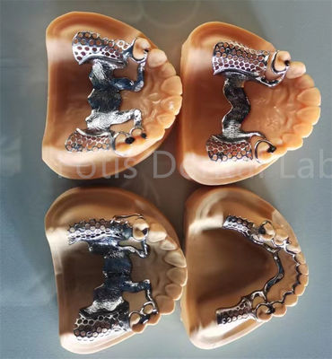 Prothèse partielle flexible amovible avec stabilité durable et confort réglable