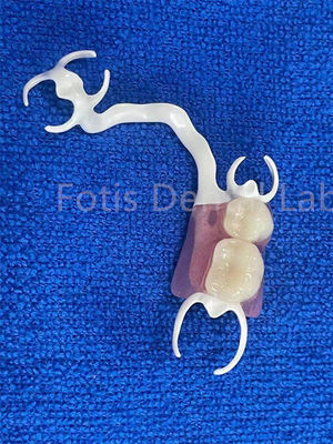 Prothèse partielle amovible confortable et personnalisable pour le remplacement de dents stables