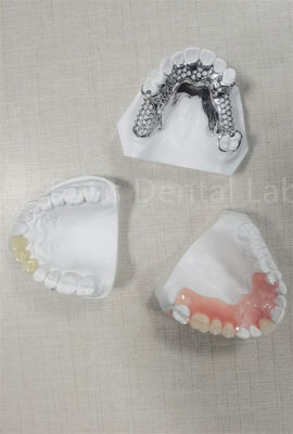 Prothèse partielle flexible et amovible, facile à nettoyer, remplaçant les dents manquantes
