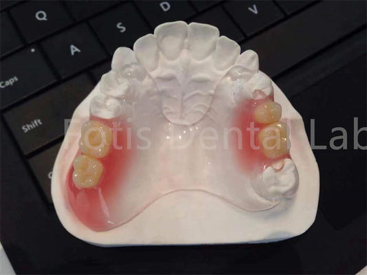 Appareils dentaires flexibles TCS Valplast Confortable Conception durable