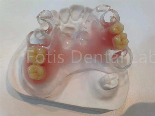 Prothèses dentaires TCS Valplast hypoallergéniques résistantes aux taches pour un confort durable