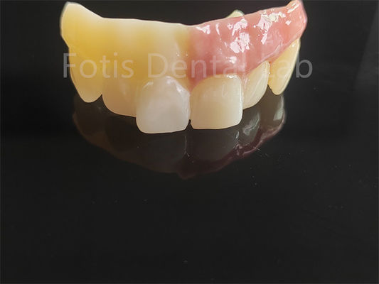 Zirconie monolithique en porcelaine