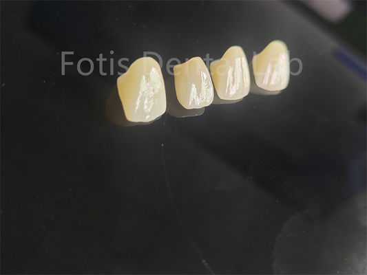 Pour des restaurations dentaires parfaitement adaptées