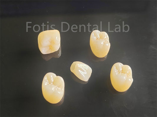 Appel esthétique Porcelaine entièrement recouverte de zirconium idéal pour les ponts de couronnes