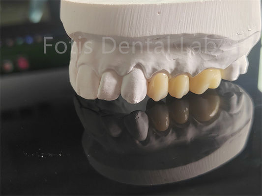 Zirconie en porcelaine couchée haute résistance pour les couronnes dentaires