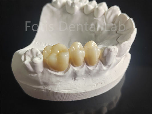 Résistant à l'usure Zirconia recouverte de matériaux dentaires en porcelaine
