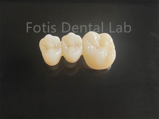 Zirconia en porcelaine à haute résistance pour les ponts dentaires durables