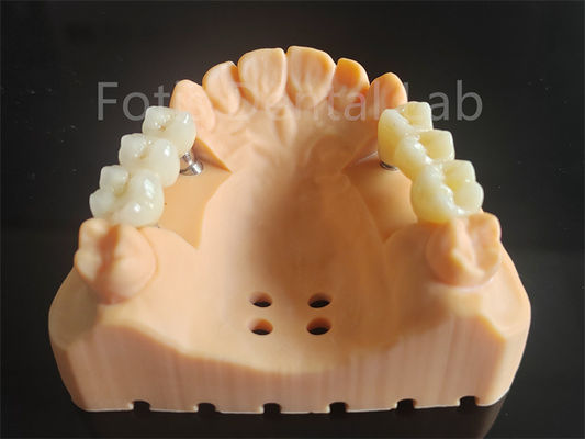 Circonia de contour complet personnalisé en porcelaine