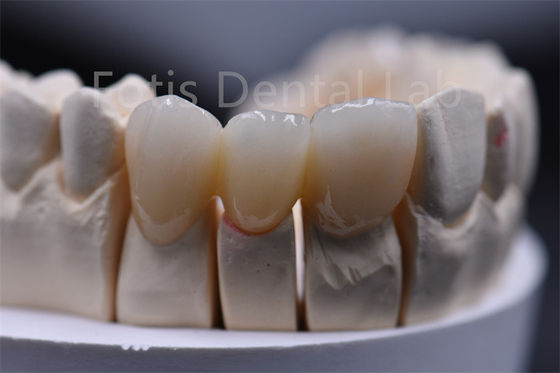 Épaisseur personnalisable Matériau dentaire en céramique de zirconium multicouche