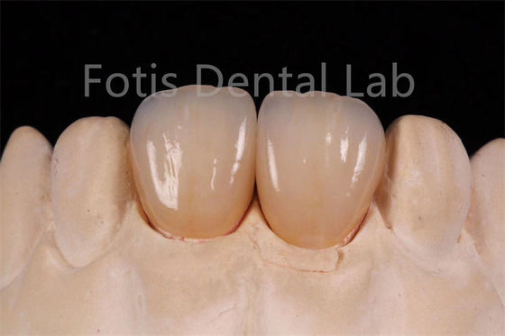 Zirconia multicouche à haute transparence pour la fabrication de restaurations dentaires