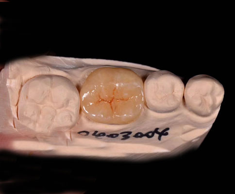 Des incrustations indirectes et en porcelaine et des incrustations avec revêtements dentaires sur mesure