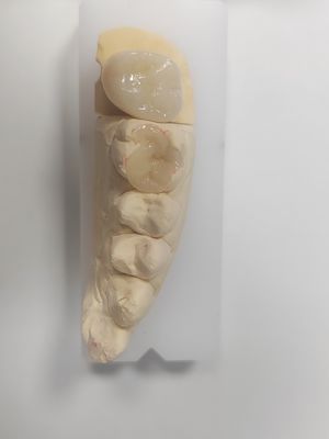Inlay et onlay dentaires pour le remplissage indirect et la restauration de la couleur des dents