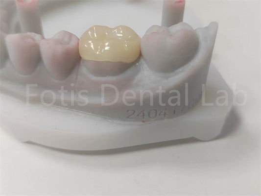 OEM Dental Inlay et Onlay Restauration en céramique et remplissage dentaire coloré