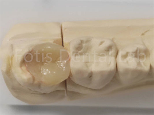 Inlay esthétique et onlay en dentisterie pour le remplissage indirect et la restauration des dents