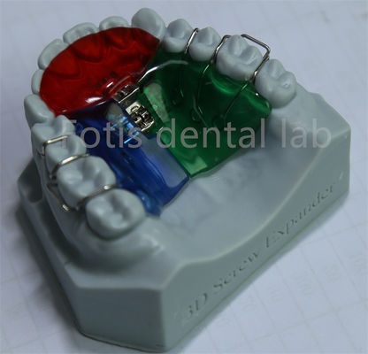 Expansion orthodontique personnalisable et réglable pour une rétention efficace des dents