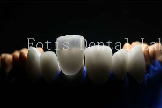 Veneurs laminés protésiques durables et durables avec matériau de porcelaine