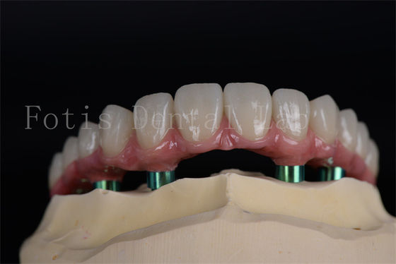 Longue durée tout sur 4 tout sur 6 Implants apparence naturelle Esthétique sans limite d'âge Rétablissement