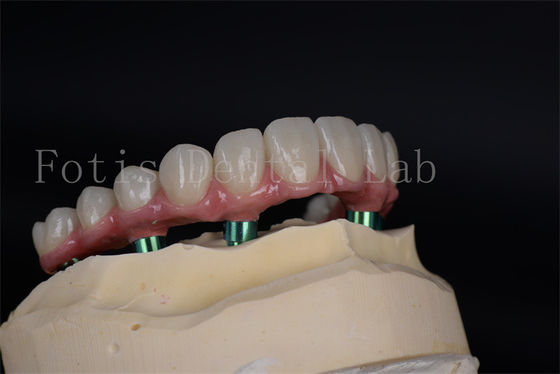 Procédure d'implant de restauration complète de la capacité de mastication pour les patients à faible densité osseuse
