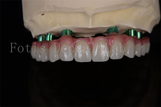 Procédure d'implant de zirconia tout sur 4 Le même jour de récupération