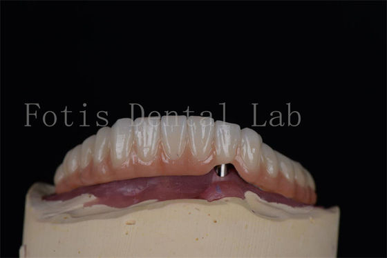 Implants dentaires naturels en titane ou en zirconium Méthode peu invasive, facile à nettoyer