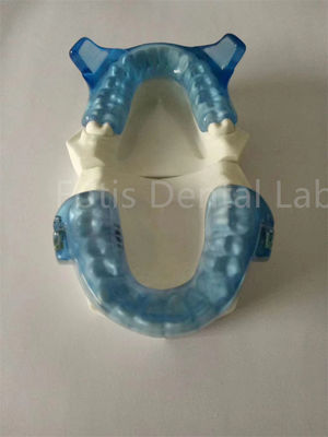 Appareil d'orthodontie avancé pour des résultats d'alignement des dents supérieurs