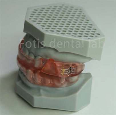 Laboratoire dentaire abordable Hyrax Expander Retenant orthodontique facile à nettoyer et à entretenir